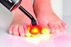 PACT® MED kit for the treatment of onychomycosis.