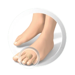 Orteza na palec młotkowy RUCK® basic, 4 szt.