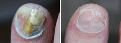 Fotodynamiczna terapia PACT® MED przeciw grzybicy paznokci