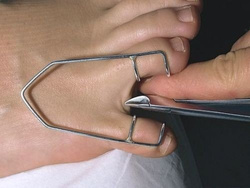 Metalowy rozwieracz międzypalcowy, mały - 1 szt.