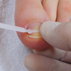 Zestaw narzędzi i klamer klejonych na wrastające paznokcie PODOSTRIPE®