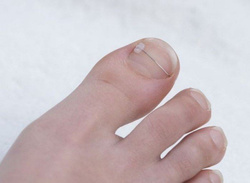 COMBIped® The intelligent adhesive-wire brace, size hard, 6 pcs.