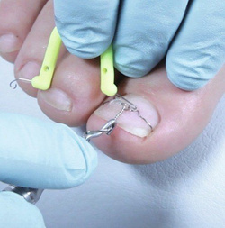 Klamry ortonyksyjne RUCK® NAGELKORREKTUR ORTOGRIP professional, rozmiar 3, 5 sztuk.