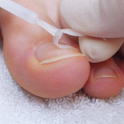 Zestaw narzędzi i klamer klejonych na wrastające paznokcie PODOSTRIPE®