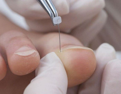 Klamra na wrastające paznokcie COMBIped, rozm hard, 6 szt.