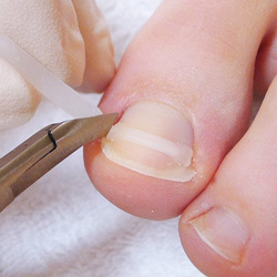 Zestaw narzędzi i klamer klejonych na wrastające paznokcie PODOSTRIPE®