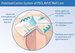 Sztyft do paznokci z grzybicą, peclavus® PODOmed AntiMYX Protectorstift, 4 ml