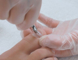 Podofix - tension tool