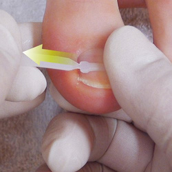 PODOSTRIPE® brace complete kit