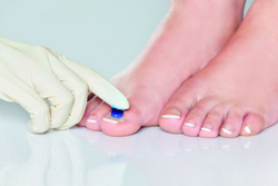 PACT® MED kit for the treatment of onychomycosis.