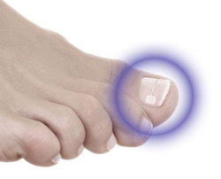 COMBIped® The intelligent adhesive-wire brace, size hard, 6 pcs.