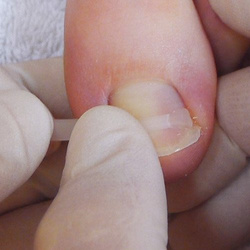 PODOSTRIPE® brace complete kit